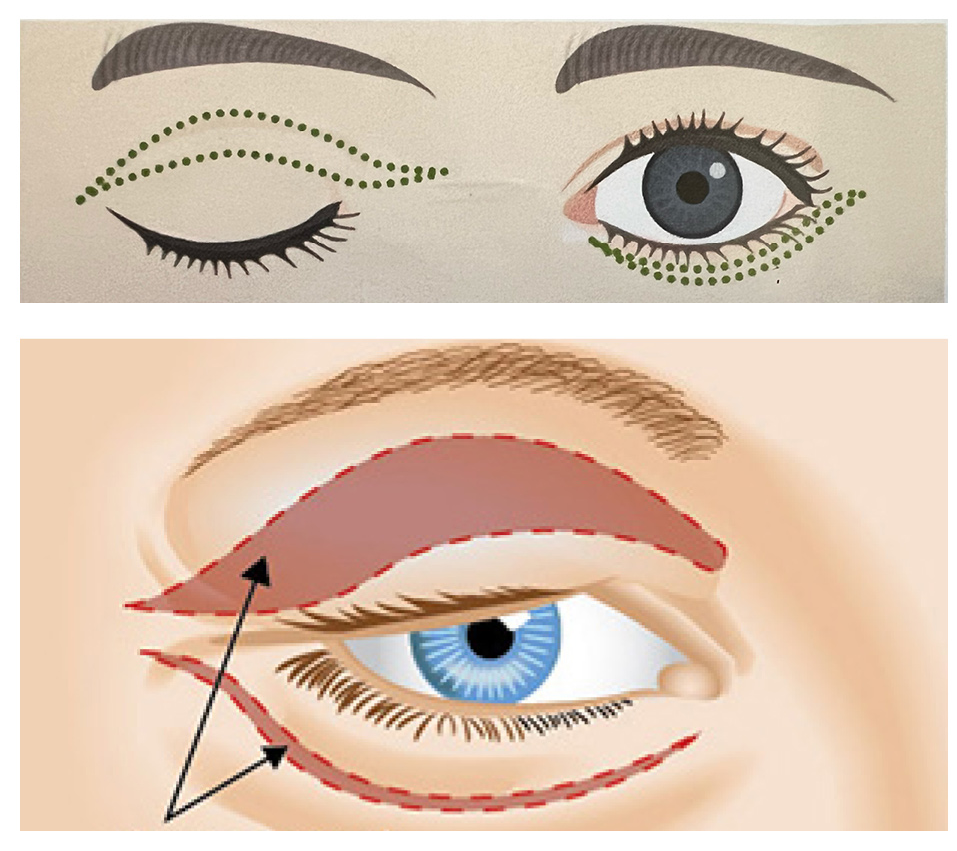 Blepharoplasty Explained: A Guide to Eyelid Rejuvenation